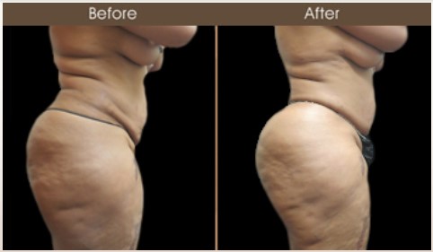Before & After Gluteal Fat Transfer Treatment